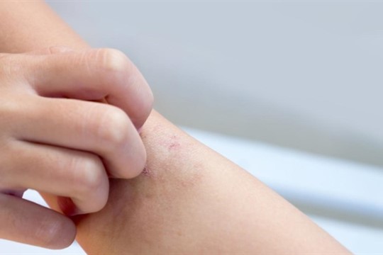 Rekordní nárůst nakažených svrabem! Nejvíce případů je v Plzeňském kraji